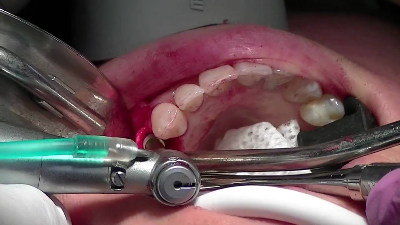Dental Implant